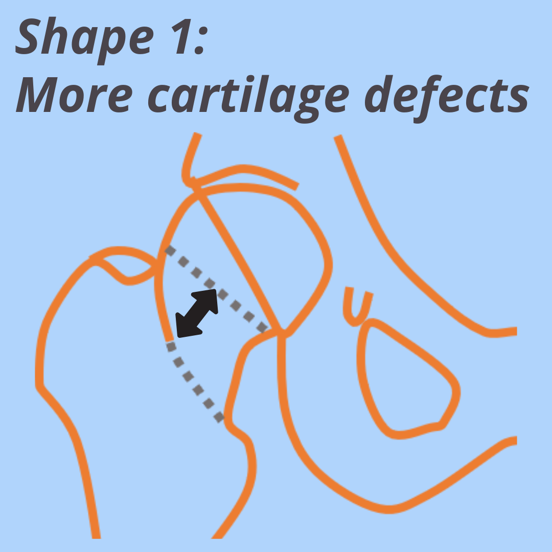 Shape 1: More cartilage defects