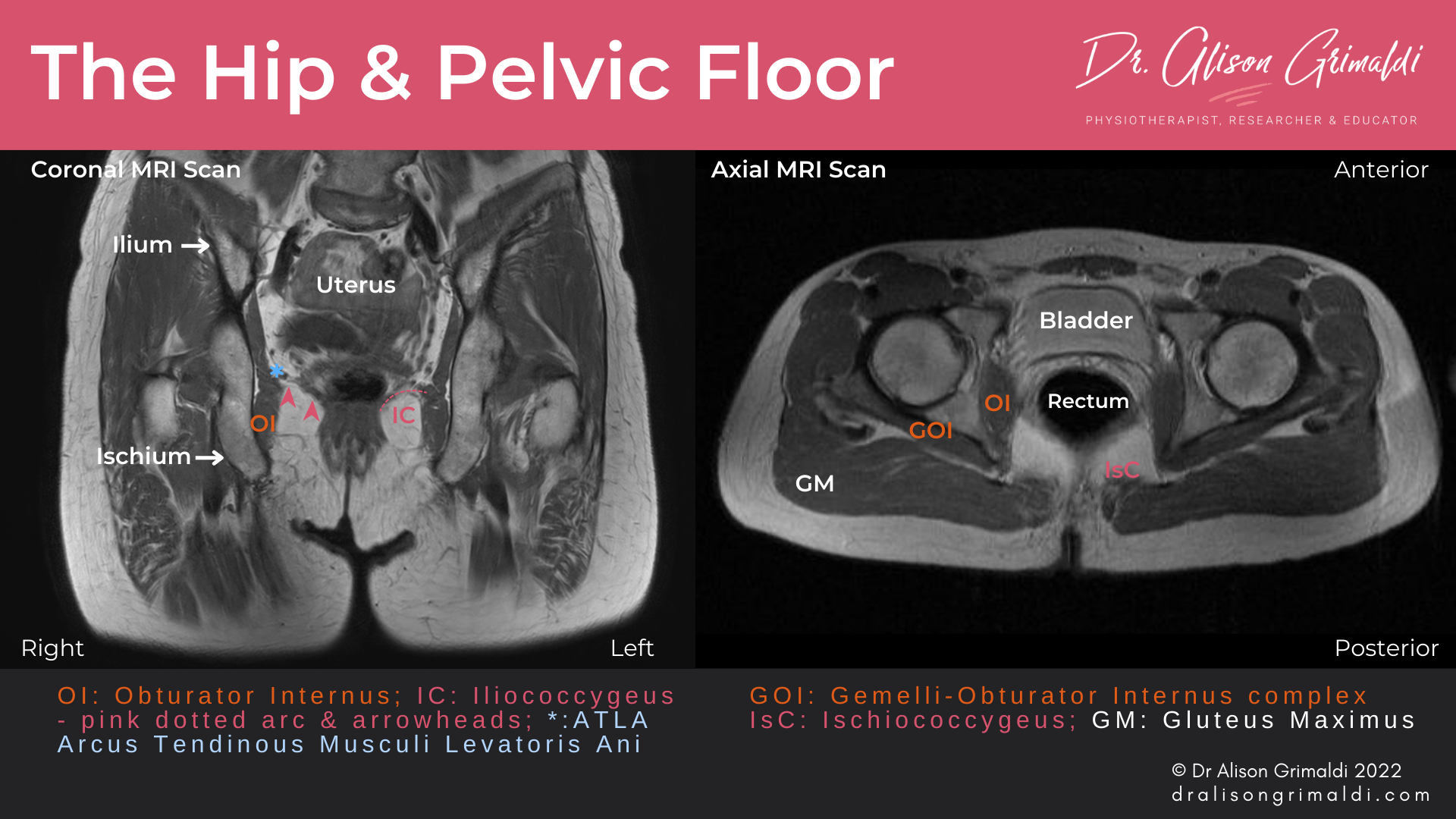 MRI Scans showing the anatomical relationships of the hip and pelvic floor