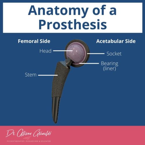 Surgical Management of Hip Osteoarthritis Types of Prostheses and Approaches Dr Alison Grimaldi
