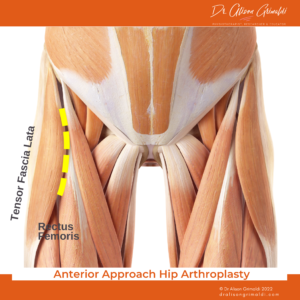 Anterior Approach Hip Arthroplasty