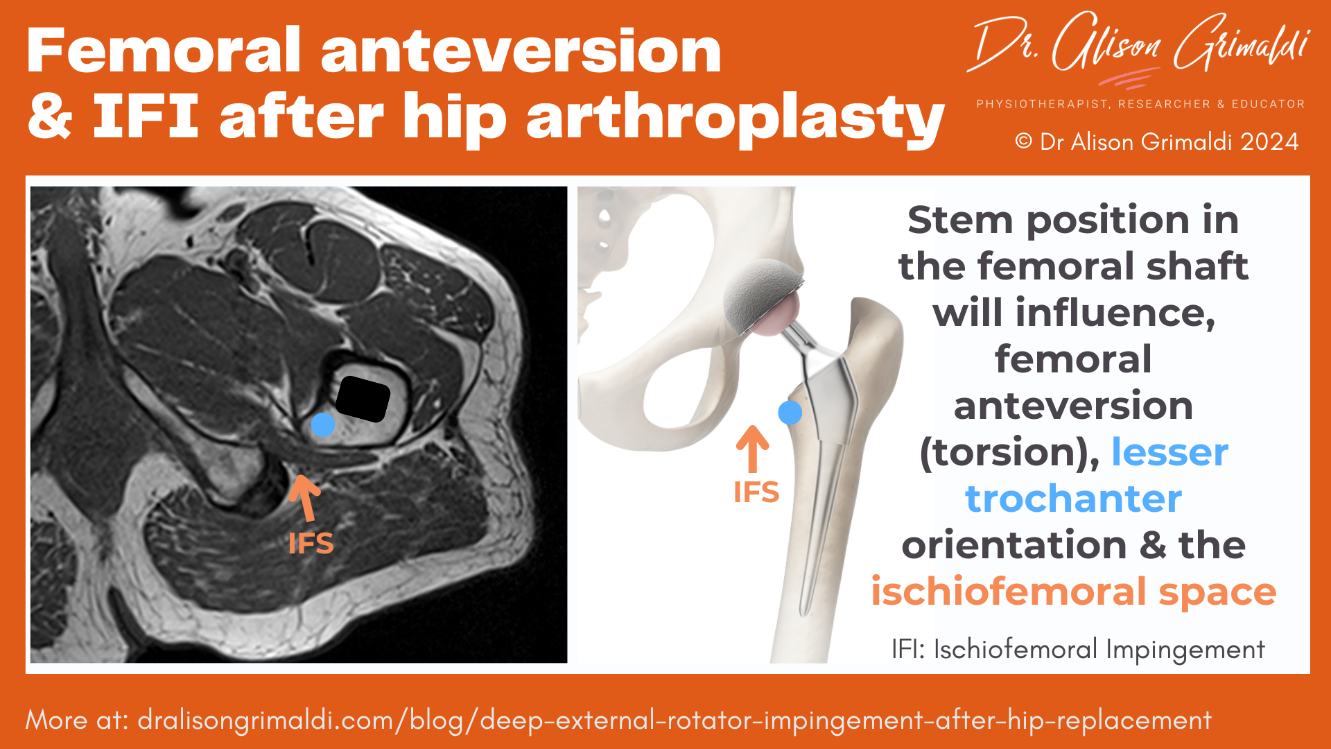femoral-anteversion-&-IFI-after-hip-arthroplasty