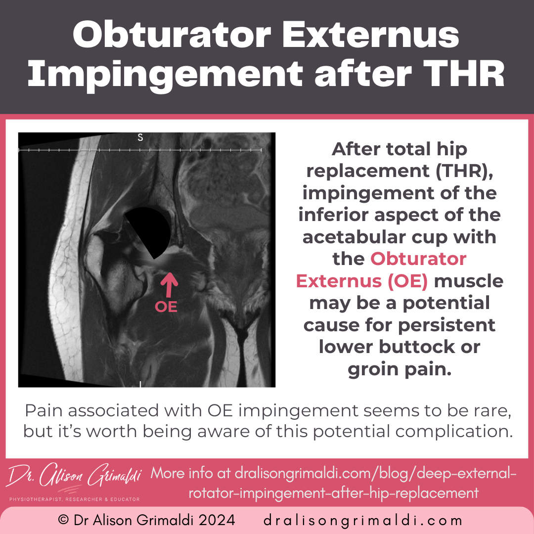 obturator-externus-impingement-after-THR