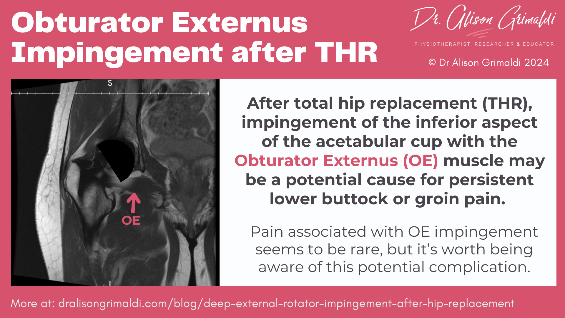 obturator-externus-impingement-after-THR