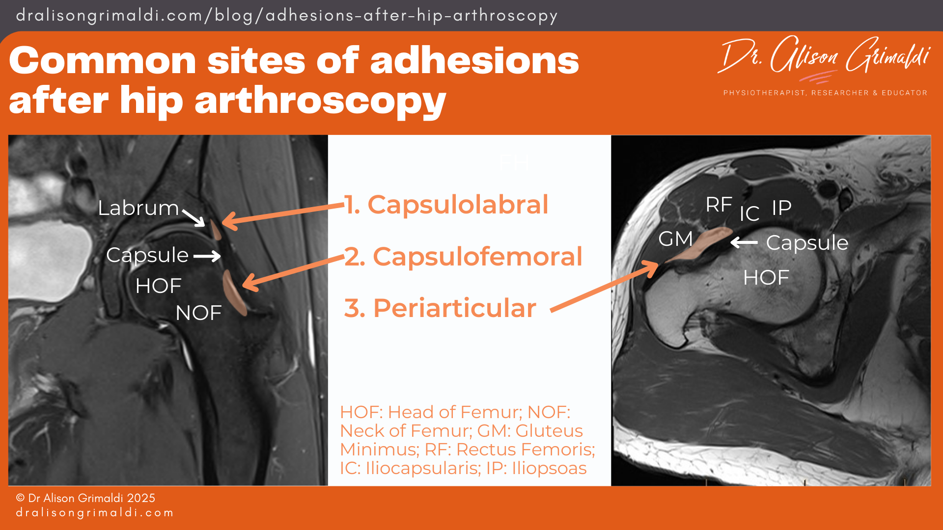 Common-sites-of-adhesions-after-hip-arthroscopy