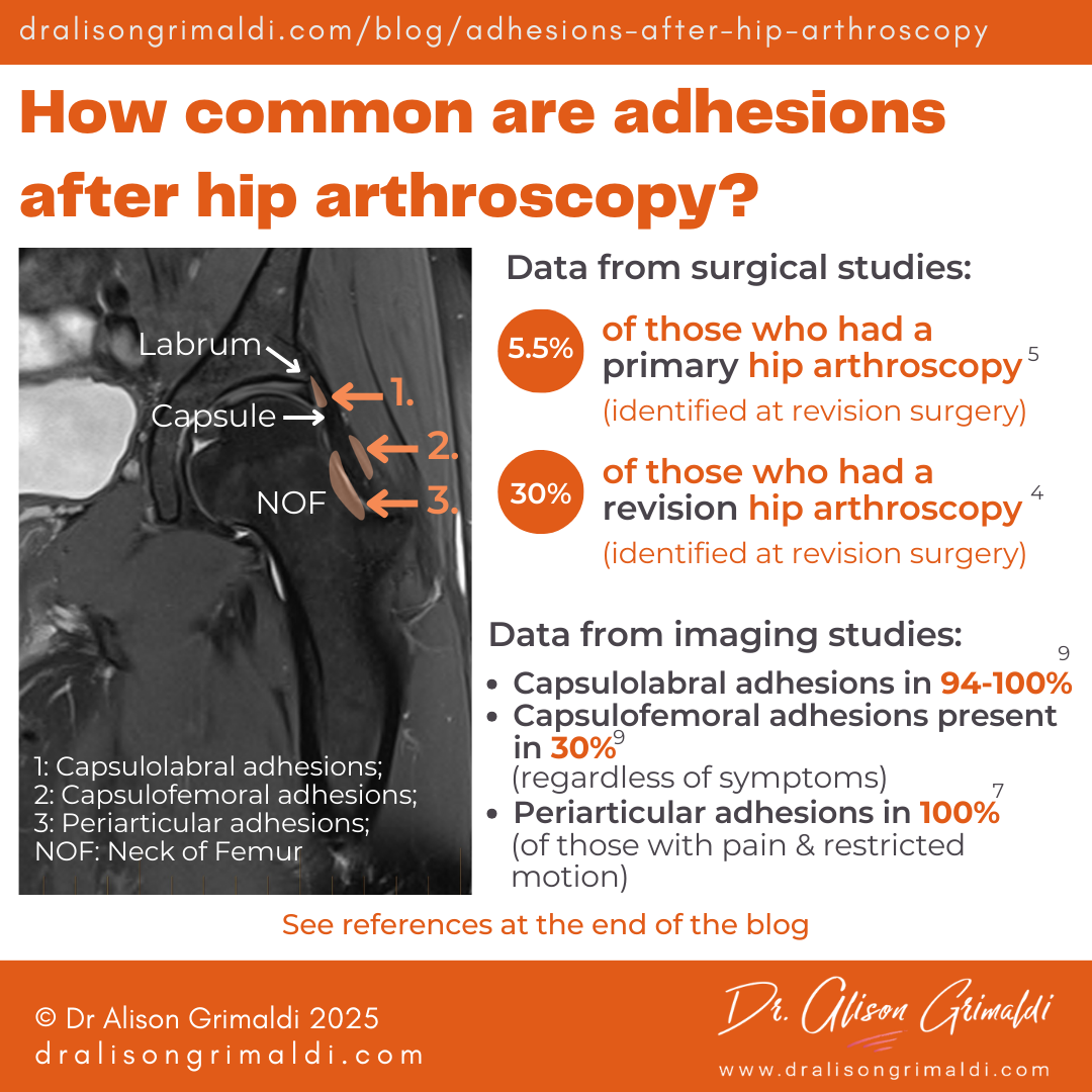How-common-are-adhesions-after-hip-arthroscopy