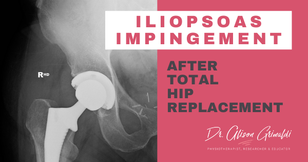 Iliopsoas Impingement after total hip replacement
