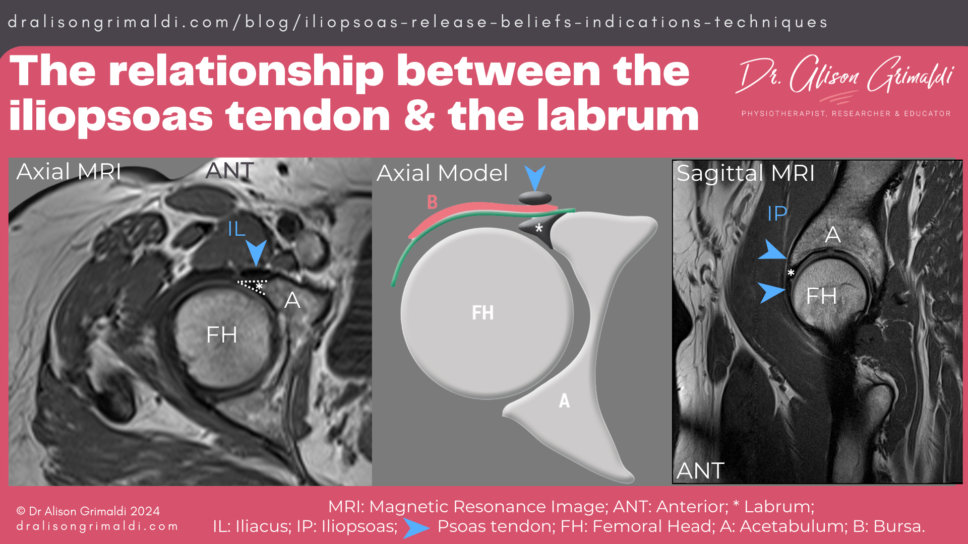 The-relationship-between-the-iliopsoas-tendon-&-the-labrum