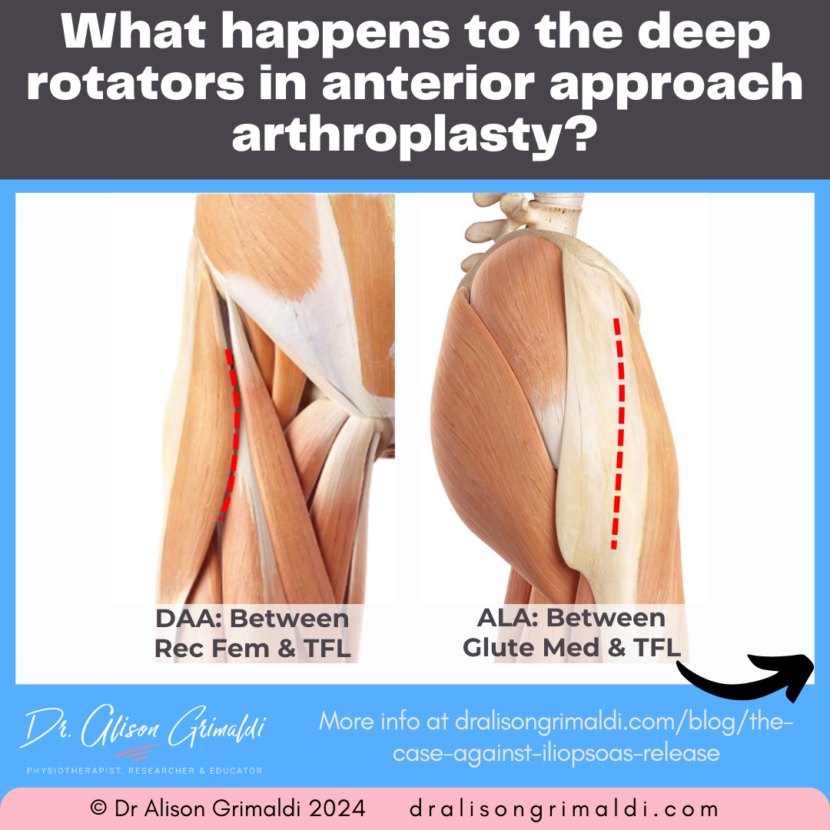 What happens to the deep external rotators after hip replacement | Find ...