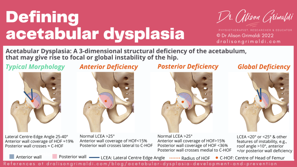 Acetabular Dysplasia: Development and Prevention | Find out more