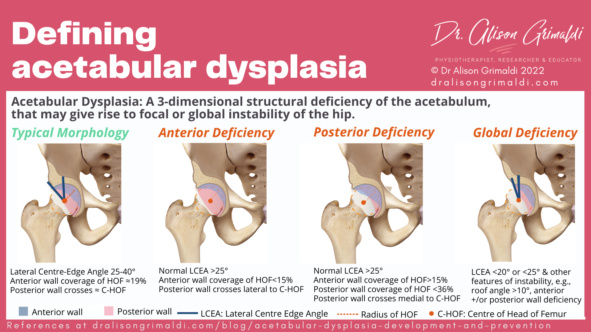 Defining acetabular dysplasia