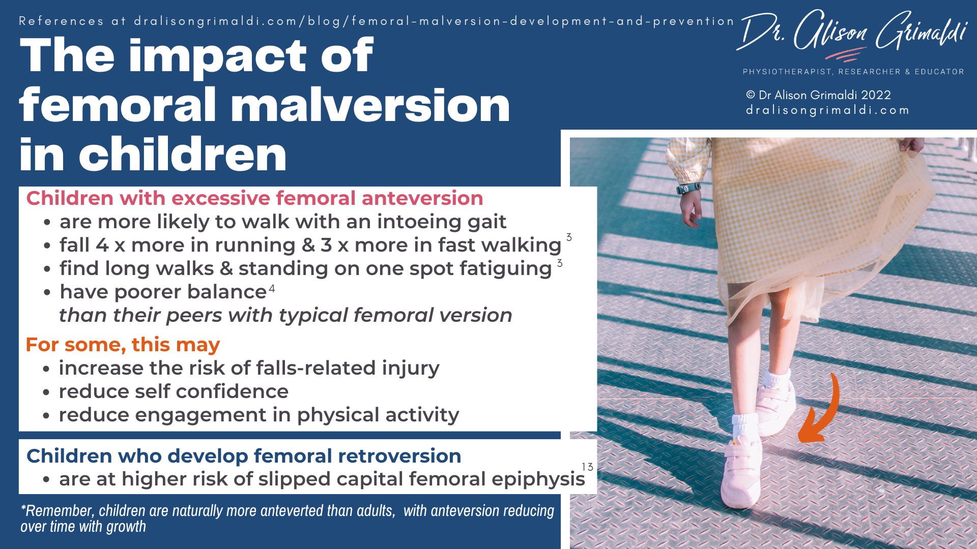 The impact of femoral malversion in children