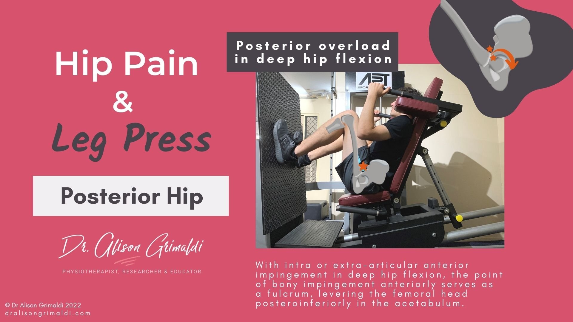 Posterior hip pain and leg press on dralisongrimaldi blog