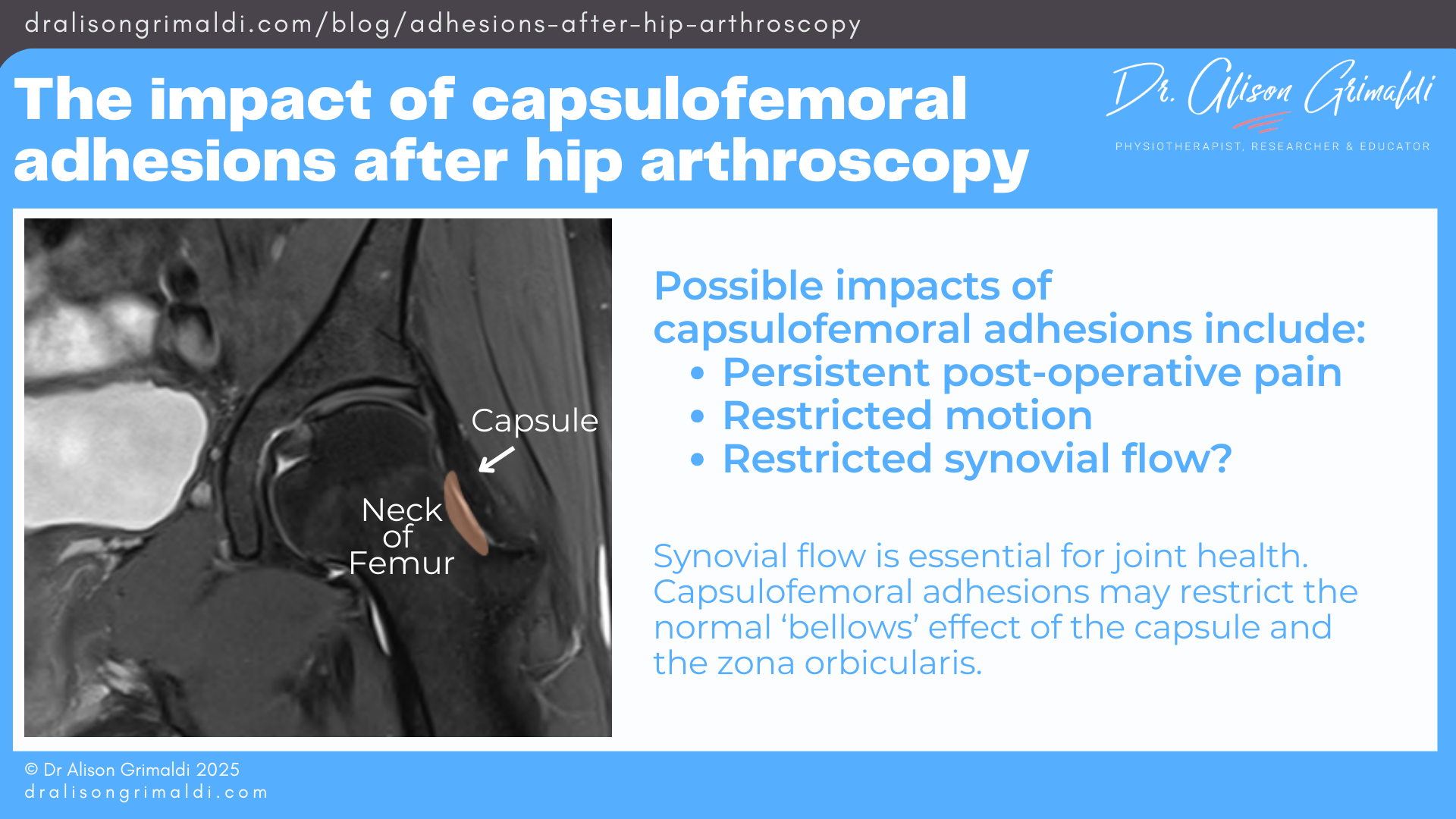The-impact-of-capsulofemoral-adhesions-after-hip-arthroscopy