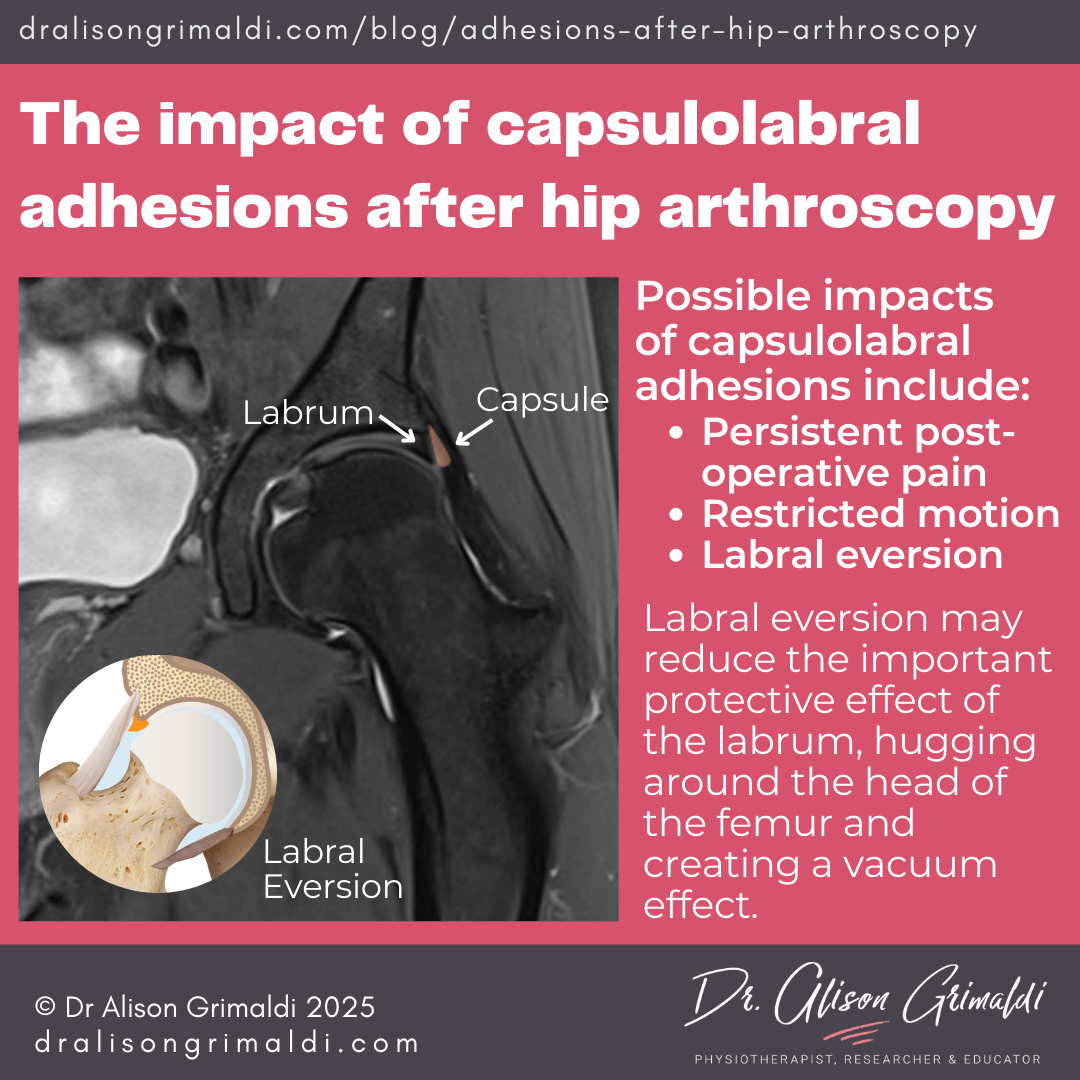 The-impact-of-capsulolabral-adhesions-after-hip-arthroscopy