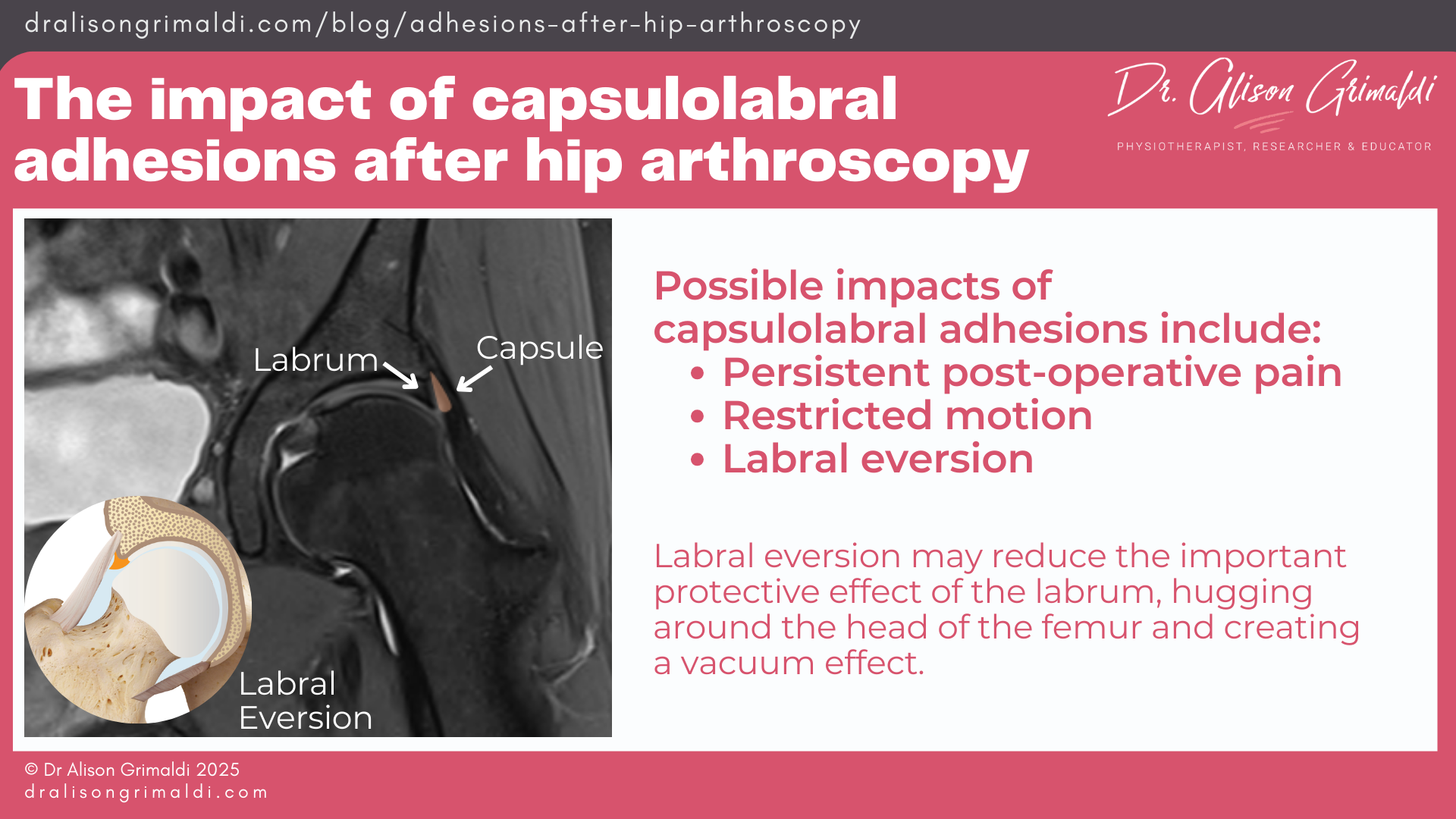 The-impact-of-capsulolabral-adhesions-after-hip-arthroscopy