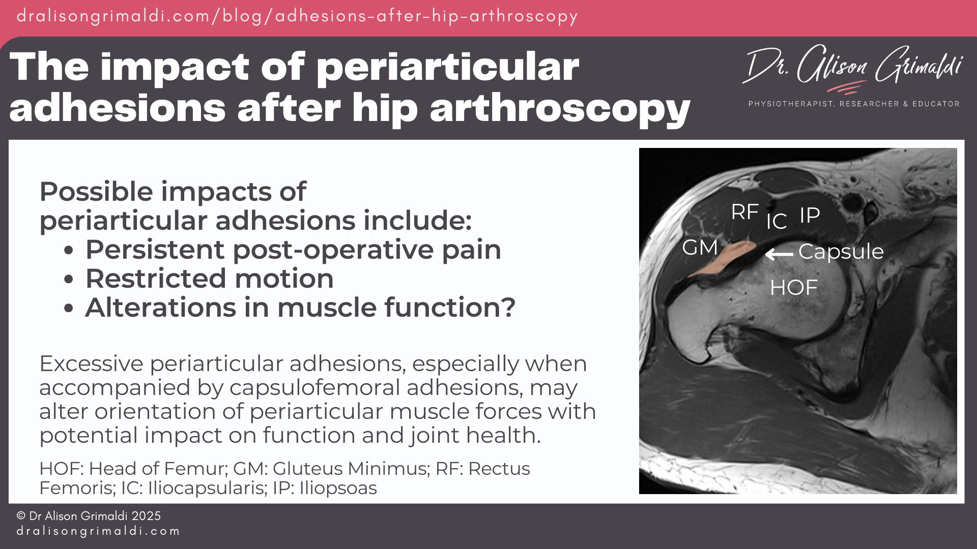 The-impact-of-periarticular-adhesions-after-hip-arthroscopy