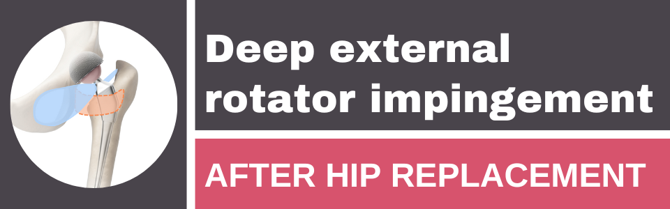 deep-external-rotator-impingement-after-hip-replacement