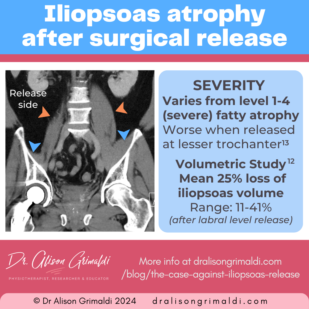 severity-of-iliopsoas-atrophy-after-surgical-release